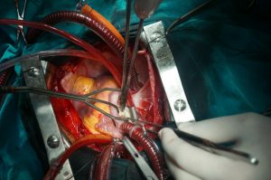 Kalp ameliyatı