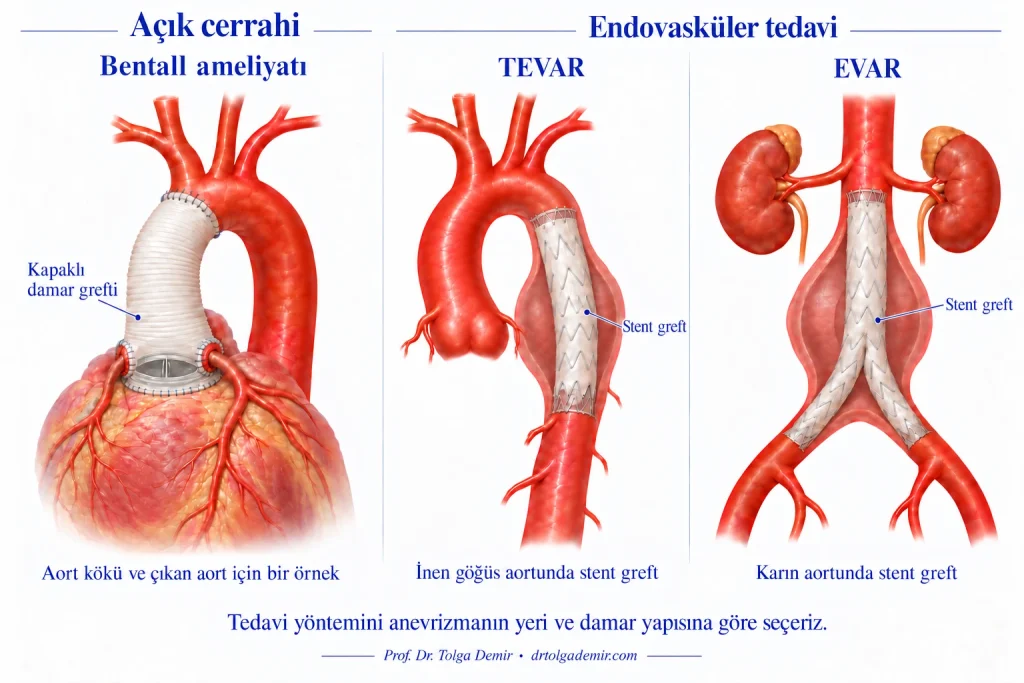 Aort anevrizması tedavisinde Bentall ameliyatı, inen torasik aortta TEVAR ve abdominal aortta EVAR yöntemlerinin karşılaştırılması.
