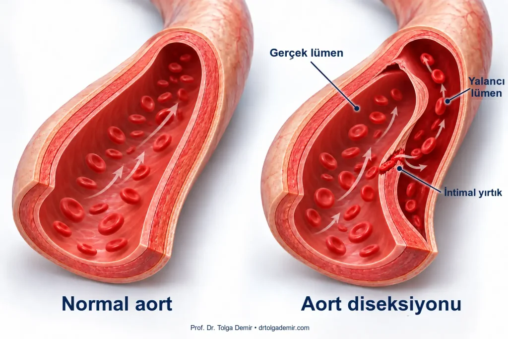 Normal aort ile aort diseksiyonunun karşılaştırılması; intimal yırtıktan yalancı lümene kan geçişi.