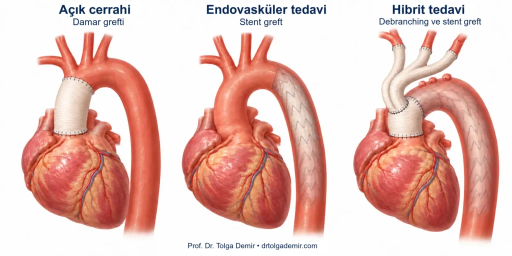 Tip A ve Tip B aort diseksiyonunun karşılaştırılması; gerçek lümen, yalancı lümen ve intimal yırtık bölgeleri.